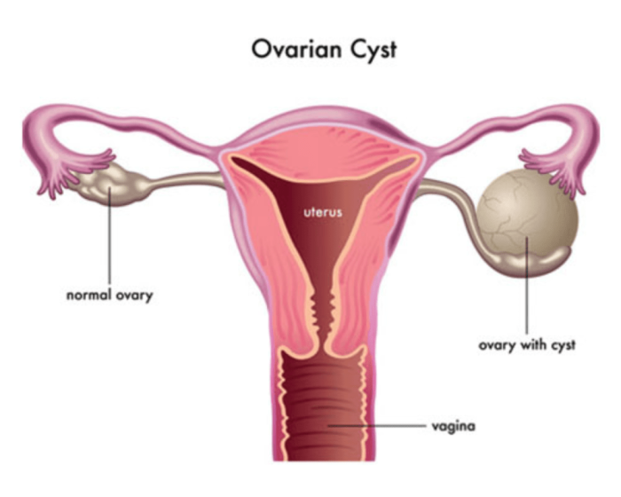 laparoscopic ovarian cystectomy